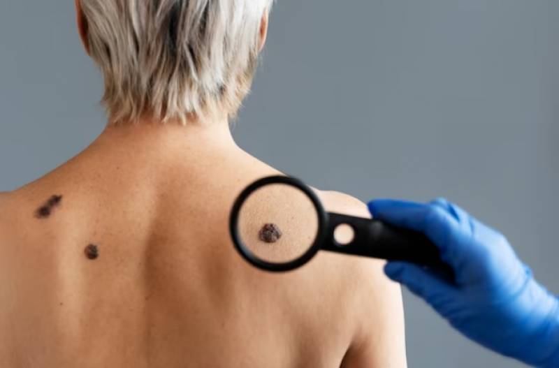 Skin cancer cases grow worryingly high in Spain