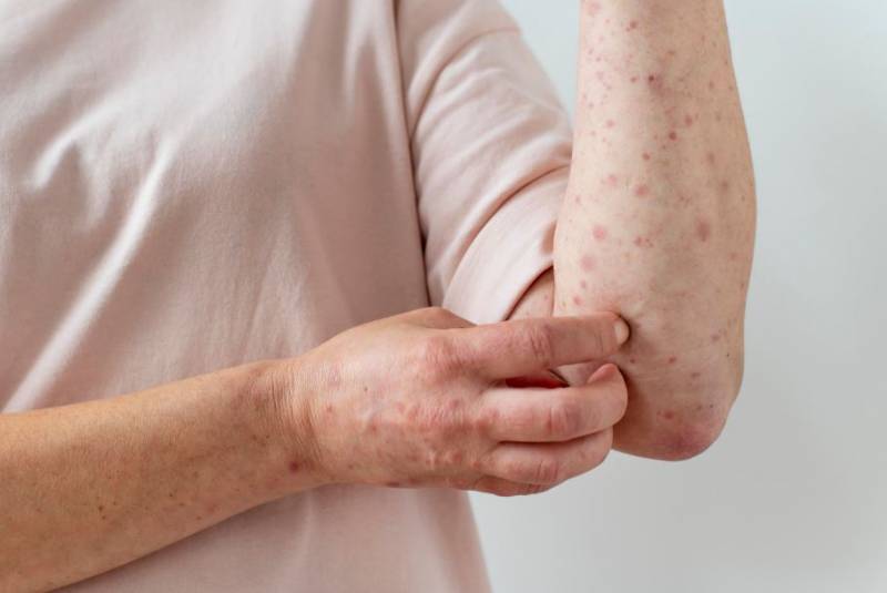 Measles outbreak hits Spain with cases surging